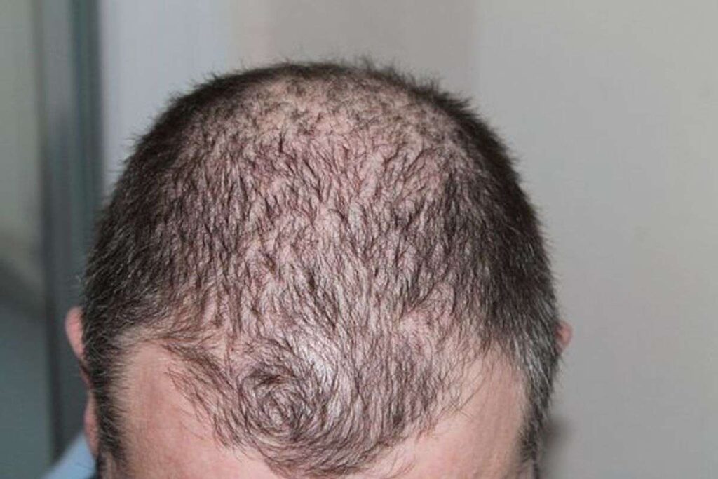 Combatting Hairloss