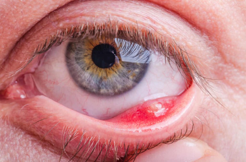 blepharitis